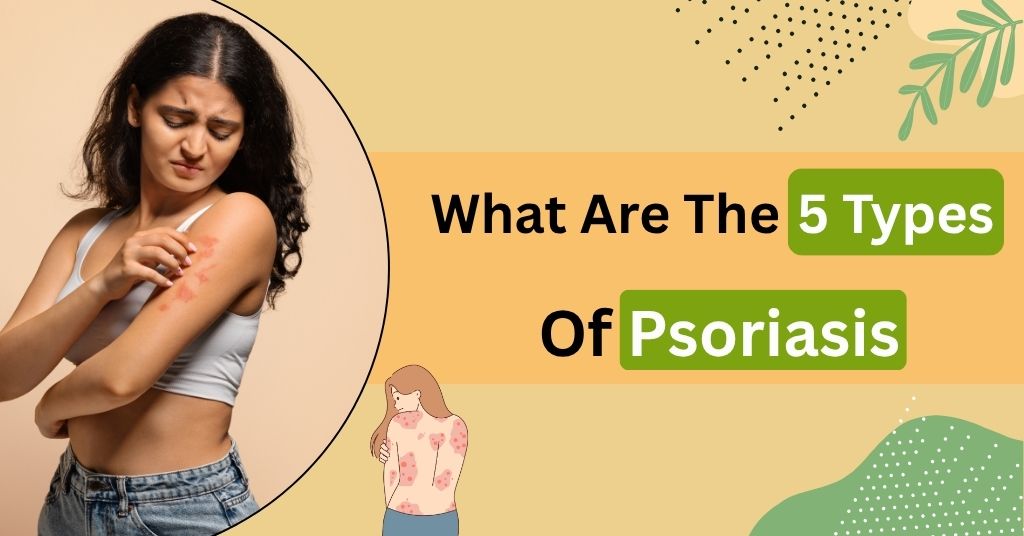 What Are The 5 Types Of Psoriasis?