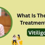 What Is The Best Treatment For Vitiligo?