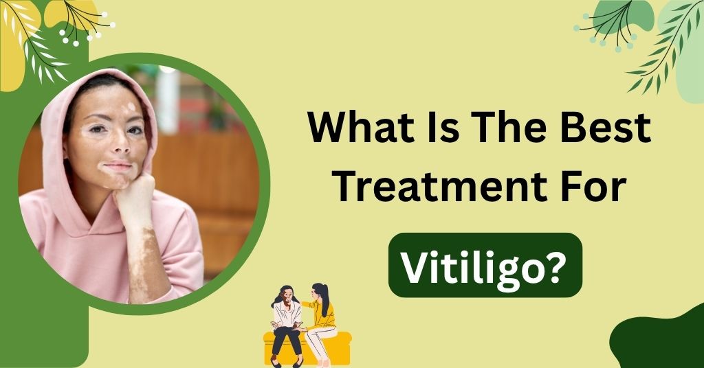 What Is The Best Treatment For Vitiligo?