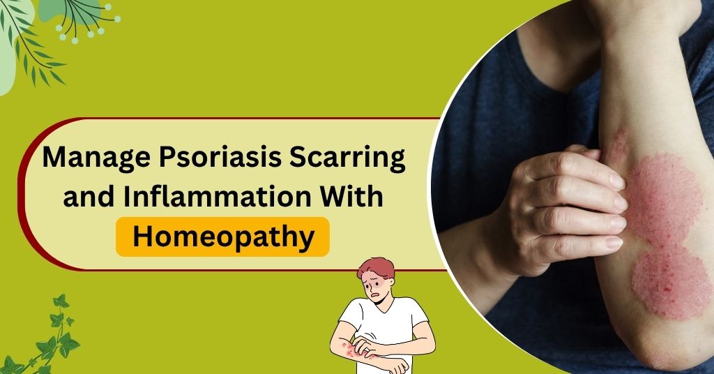 Manage Psoriasis Scarring and Inflammation With Homeopathy