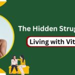 The Hidden Struggles of Living with Vitiligo