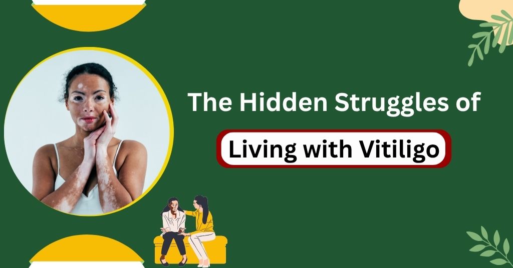 The Hidden Struggles of Living with Vitiligo