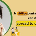 Is vitiligo contagious, and can it spread to others?