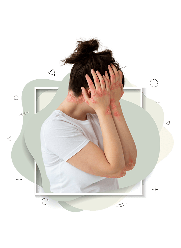 Psoriasis Disease