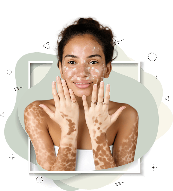 Vitiligo Disease