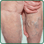 Superficial Thrombophlebitis