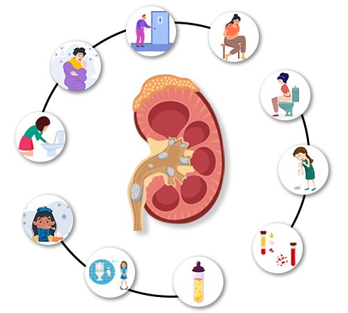 Symptoms of Kidney Stone