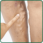 Varicose Eczema