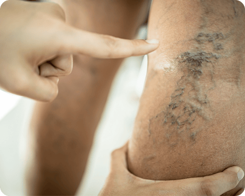 When painful varicose vein symptoms appear