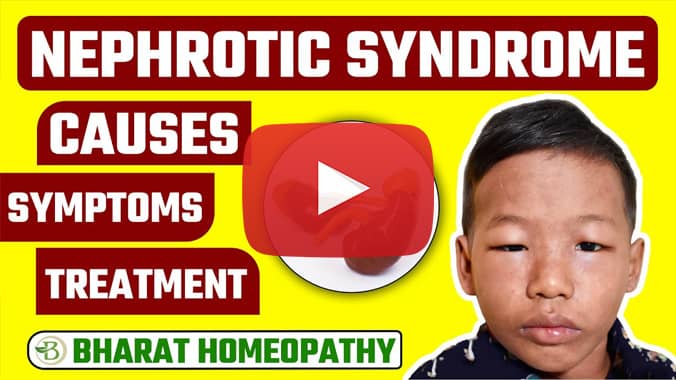 Nephrotic Syndrome Treatment | Bharat Homeopathy