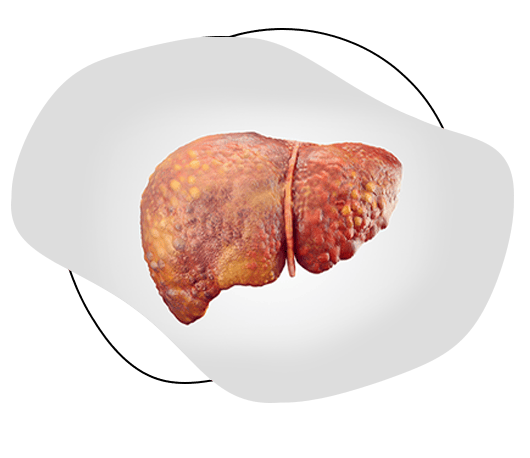 Alcohol associated Liver Disease