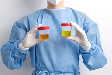 Darkened Color of the Urine