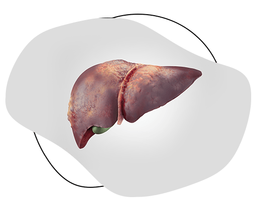 Fatty Liver Disease