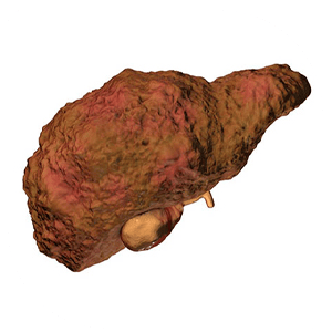 Liver Cirrhosis