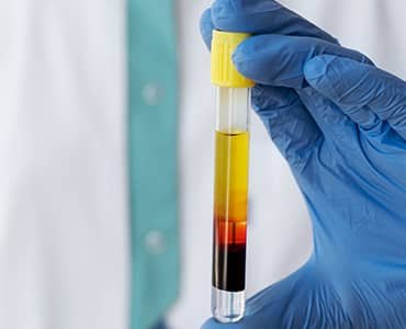 Blood in the urine