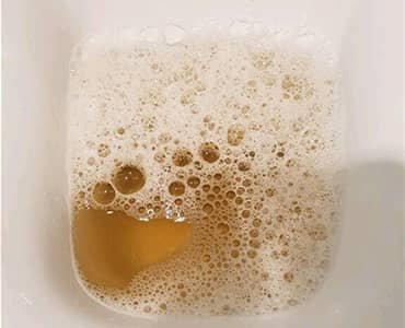 Foamy or bubbly urine