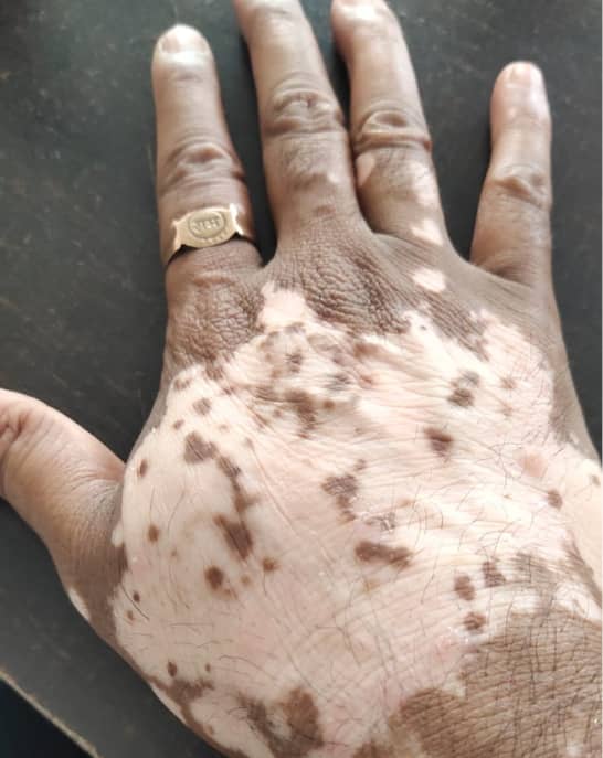 Let's Understand Vitiligo