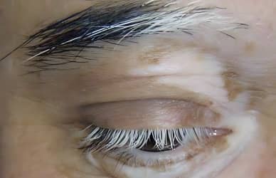 Eyebrows or eyelashes turning white and losing colour