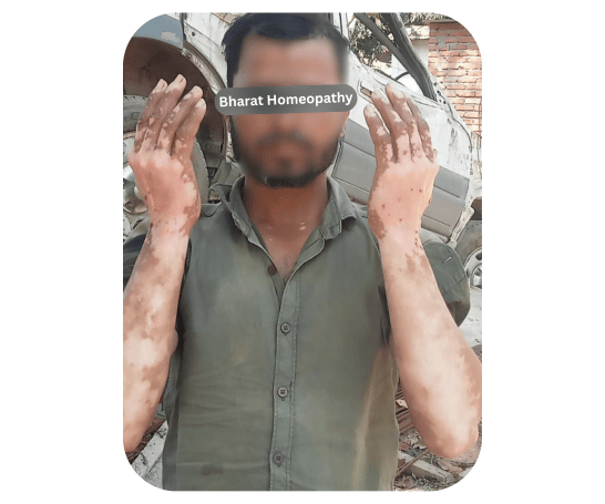 What leads to Vitiligo?